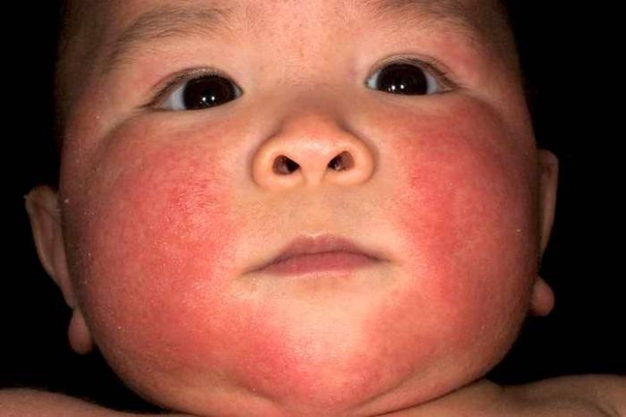 än att behandla dermatit hos spädbarn