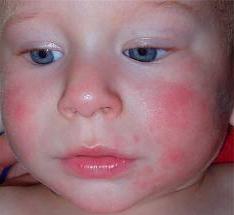 allergi hos ett barn upp till ett år