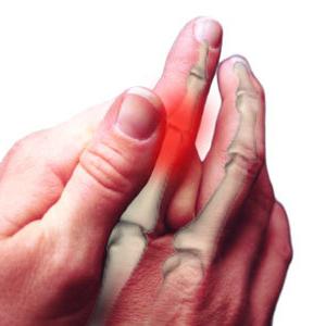 Artrit av fingrarna: behandling, orsaker, symtom