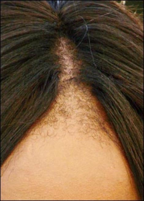 Medel mot håravfall: hitta och eliminera orsaken